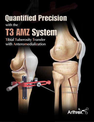 Quantified Precision with the T3 AMZ System - Tibial Tuberosity Transfer with Anteromedialization - LS0145