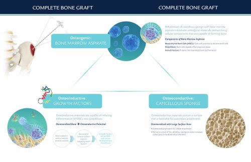 complete bone graft