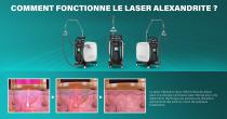 Perfectlaser Z110Pro Máquina de depilación láser de pulso largo Alejandrita - 15