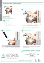 Technique opératoire - Reconstruction de la coiffe des rotateurs - FIXIT®/FIXIT® Knotless-6