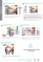 Technique opératoire - Reconstruction de la coiffe des rotateurs - FIXIT®/FIXIT® Knotless-8