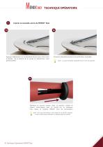 Technique opératoire - Réparation méniscale - MENIX® DUO-4